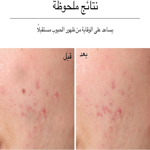 غسول الوجه للتحكم في البقع بلس  حمض الساليسيليك والجليكوليك- من نيتروجينا